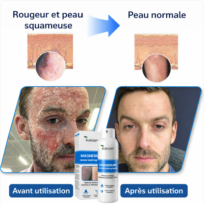 Spray Soulagement rapide du psoriasis et de l'eczéma