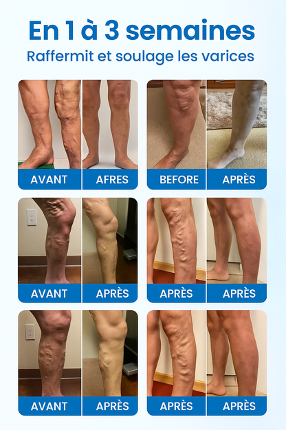 spray anti-varices