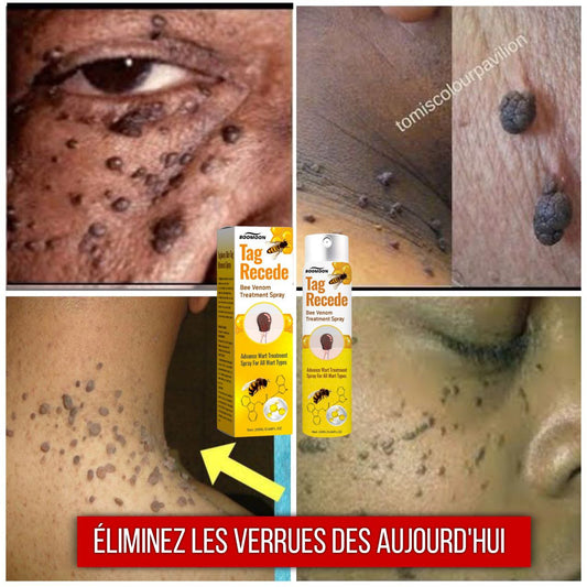 Spray Anti-Verrues Venin d'Abeille
